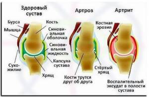Чем отличается артрит от артроза коленного сустава