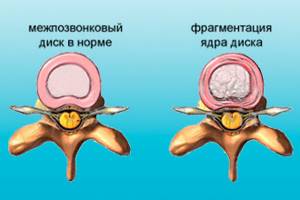 Взаимосвязь шейного остеохондроза и артериального давления. Лечение гипертонии