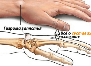 Гигрома запястья (лучезапястного сустава кисти): симптомы, лечение