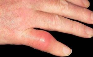 Как лечить суставы пальцев рук в домашних условиях