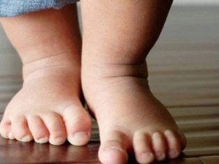Вальгусная деформация стопы у детей: фото, лечение, причины, симптомы