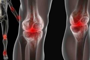 Артралгия коленных и тазобедренных: симптомы и лечение