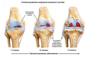 Гонартроз коленного сустава: что такое, лечение, симптомы, причины