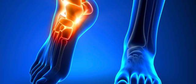 Таранно-ладьевидный сустав: причины артроза, признаки и лечение