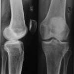 Менисцит коленного сустава: диагностика и лечение симптомов