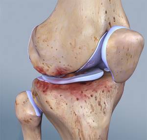 Посттравматический артроз суставов: причины, диагностика, лечение и профилактика