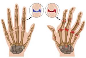 Полиартрит пальцев рук: лечение (народное, медикаментозное), симптомы, причины, диета