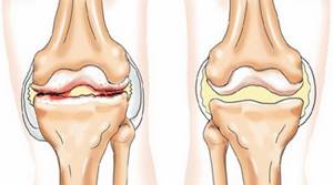 Дегенеративные изменения менисков коленного сустава: диагностика и лечение