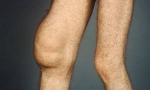 Синовиальный хондроматоз коленного сустава: симптомы и лечение