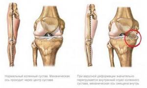 Деформирующий артрит суставов: симптомы и лечение