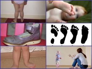 Вальгусная деформация стопы у детей: лечение методом Комаровского