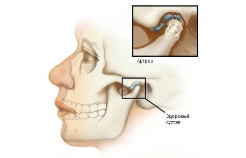 Артроз челюстного сустава: причины, симптомы и лечение