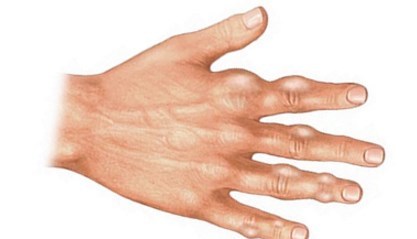 Болезни суставов пальцев рук: лечение основных диагнозов