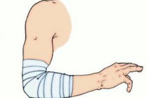 Воспаление локтевого сустава: виды, причины, лечение