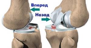 Лечение растяжения и разрыва связок коленного сустава в домашних условиях