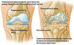 Деформирующий остеоартроз: лечение, симптомы и профилактика