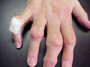 Артрит пальцев рук: диагностика, лечение, профилактика и фото болезни