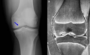 Болезнь Кенига коленного сустава: лечение, причины, симптомы