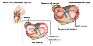 Менископатия коленного сустава: симптомы и лечение