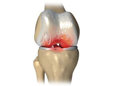 Народные средства лечение деформирующего артроза коленного сустава