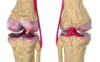 Хондропротекторы при артрозе коленного сустава: какие лучше, классификация