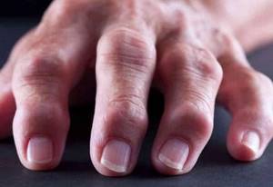 Лечение артрита пальцев рук в домашних условиях народными средствами