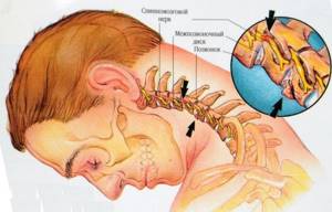 Межпозвонковый остеохондроз: причины, симптомы, схема лечения