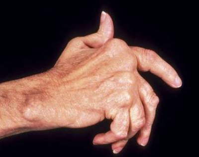 Болезни суставов пальцев рук: лечение основных диагнозов