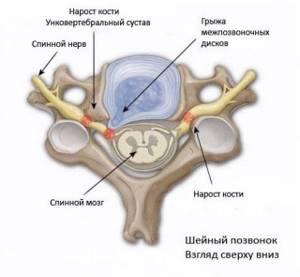 Унковертебральный артроз шейного отдела позвоночника: лечение, симптомы, причины заболевания