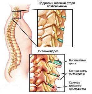 Симптомы шейного остеохондроза: все основные признаки болезни