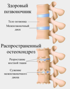 Распространенный остеохондроз шейного, грудного и поясничного отдела позвоночника