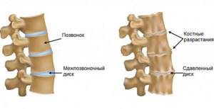 Способы лечения симптомов остеоартроза позвоночника: медикаменты и процедуры