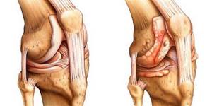 Как лечить артрит коленного сустава в домашних условиях