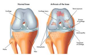 Лечение мениска коленного сустава без операции в домашних условиях
