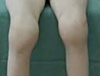 Инфекционный артрит коленного сустава: симптомы и лечение