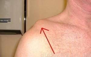 Разрыв акромиальной связки плеча: что делать?