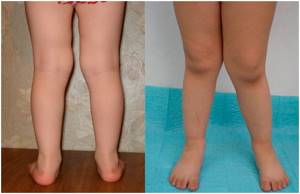 Вальгусная деформация коленных суставов у детей и взрослых