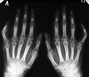 Чем лечить артрит кистей рук: способы, медикаменты и рецепты