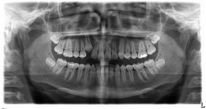Артроз челюстного сустава: причины, симптомы и лечение