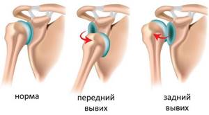 Вывих плеча (плечевого сустава): привычный вывих, подвывих - лечение